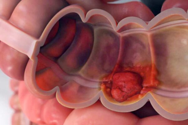 cancercolorectal